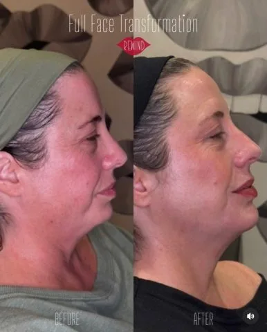 Full Face Transformation - Case 1 before and after