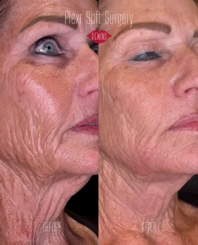 PLEXR Soft Surgery - Case 1 before and after at Rewind Aesthetics (2 of 4)