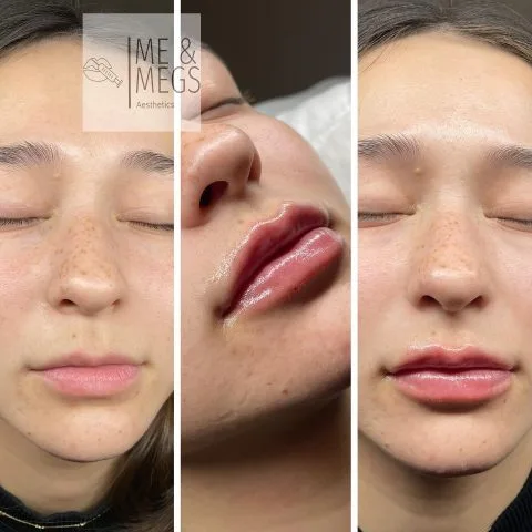 Lip Filler - Case 23 before and after at Rewind Aesthetics (2 of 2)