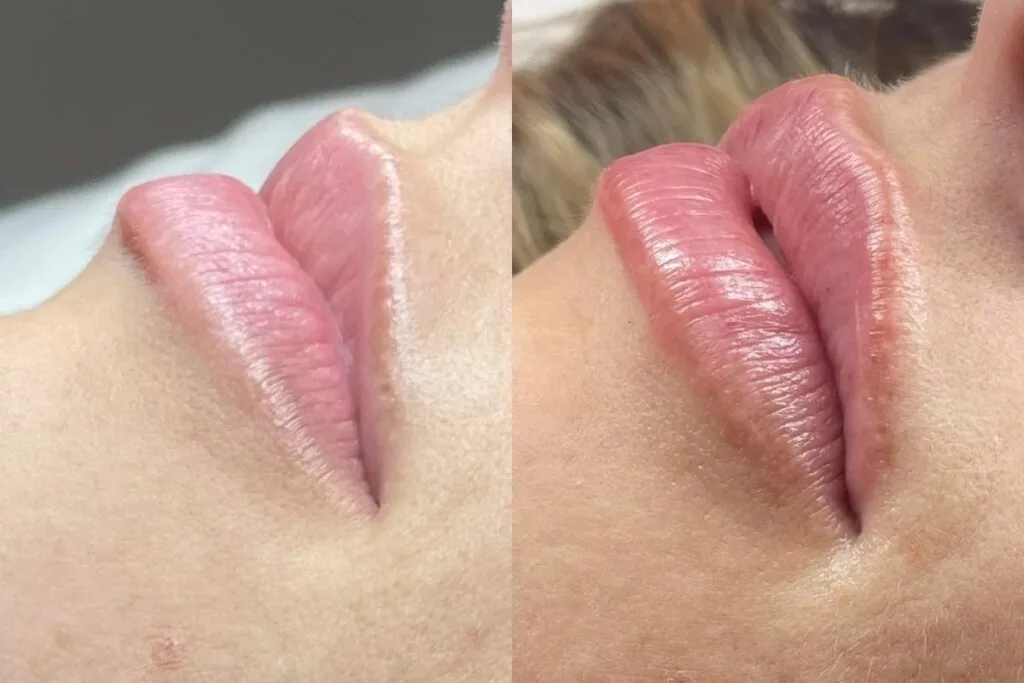 Lip Filler - Case 3 before and after
