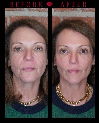 Radiesse - Case 2 before and after at Rewind Aesthetics (2 of 5)