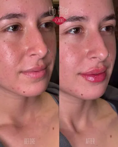 Lip Filler - Case 9 before and after