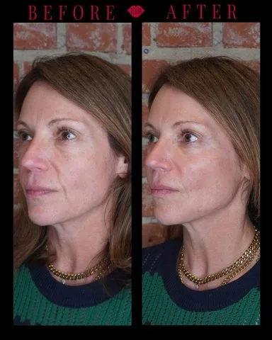 Radiesse - Case 2 before and after