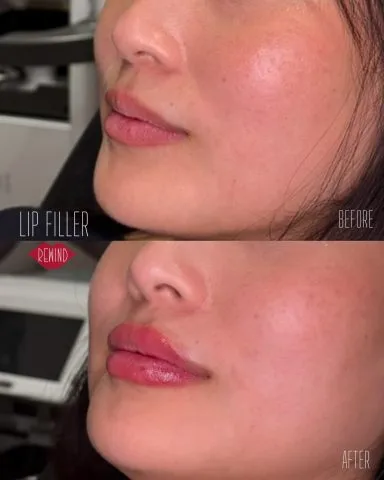 Lip Filler - Case 7 before and after at Rewind Aesthetics (3 of 3)