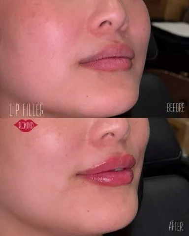 Lip Filler - Case 7 before and after at Rewind Aesthetics (2 of 3)