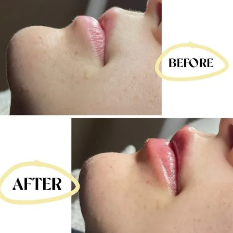 Lip Filler - Case 22 before and after