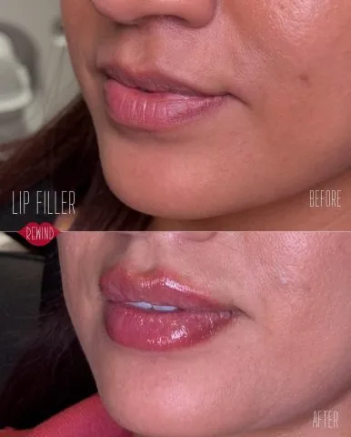 Lip Filler - Case 8 before and after at Rewind Aesthetics (2 of 2)