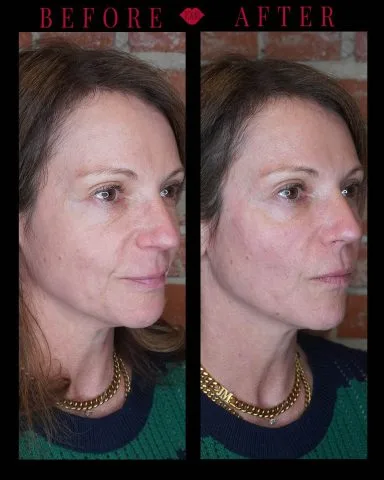 Radiesse - Case 2 before and after at Rewind Aesthetics (4 of 5)