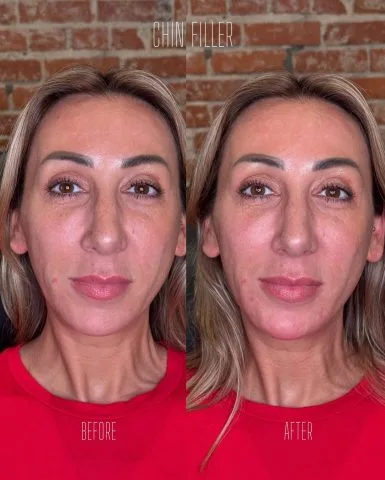 Chin Filler - Case 1 before and after at Rewind Aesthetics (3 of 3)