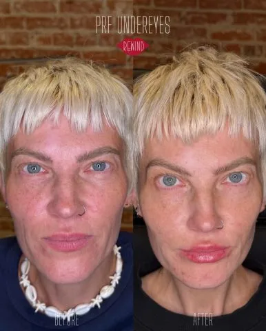 PRF - Case 1 before and after at Rewind Aesthetics (2 of 2)