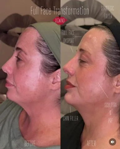 Full Face Transformation - Case 1 before and after at Rewind Aesthetics (2 of 2)