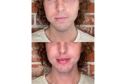 Lip Filler - Case 5 before and after