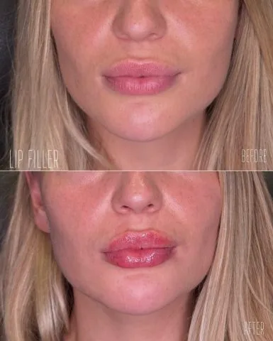 Lip Filler - Case 12 before and after at Rewind Aesthetics (2 of 3)