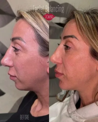 Facial Balancing - Case 2 before and after