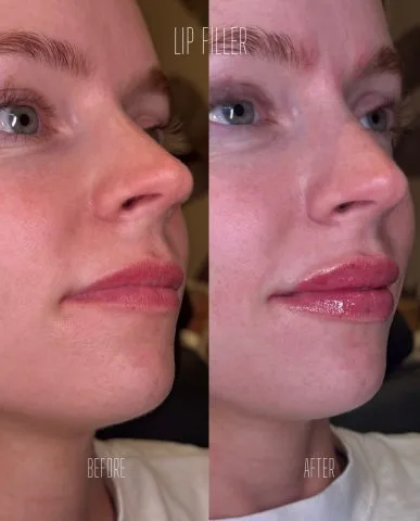 Lip Filler - Case 18 before and after
