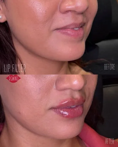 Lip Filler - Case 8 before and after