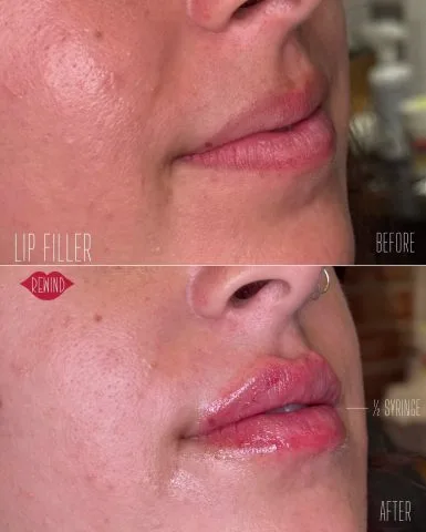 Lip Filler - Case 14 before and after
