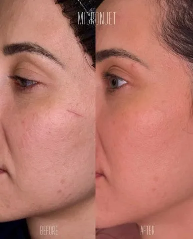 Micronjet - Case 1 before and after