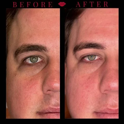 IPL - Case 2 before and after