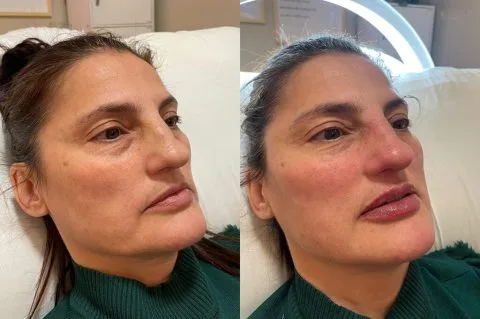 Sculptra - Case 2 before and after at Rewind Aesthetics (2 of 2)