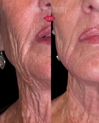 PLEXR Soft Surgery - Case 1 before and after at Rewind Aesthetics (4 of 4)