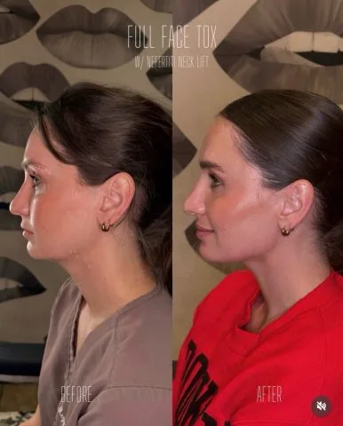 Full Face Tox with Nefertiti Neck Lift before and after