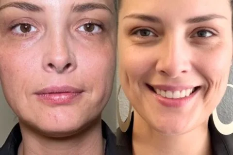 Sculptra - Case 1 before and after