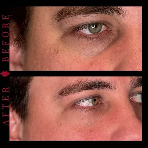 IPL - Case 2 before and after at Rewind Aesthetics (2 of 2)