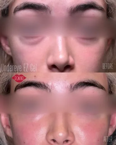 EZ Gel - Case 6 before and after