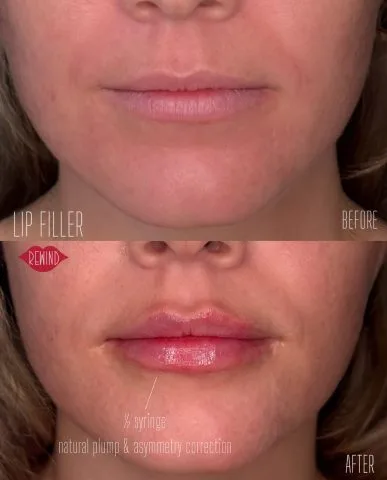 Lip Filler - Case 17 before and after