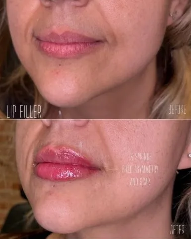 Lip Filler - Case 19 before and after