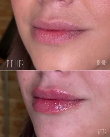 Lip Filler - Case 15 before and after