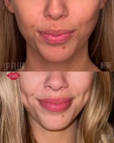 Lip Filler - Case 16 before and after at Rewind Aesthetics (3 of 3)