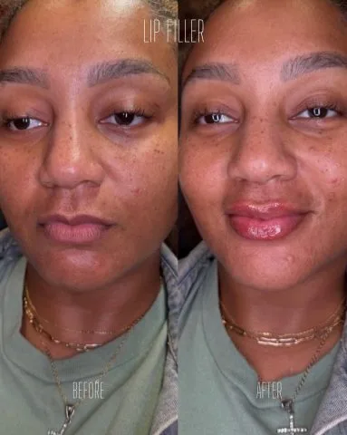 Lip Filler - Case 10 before and after