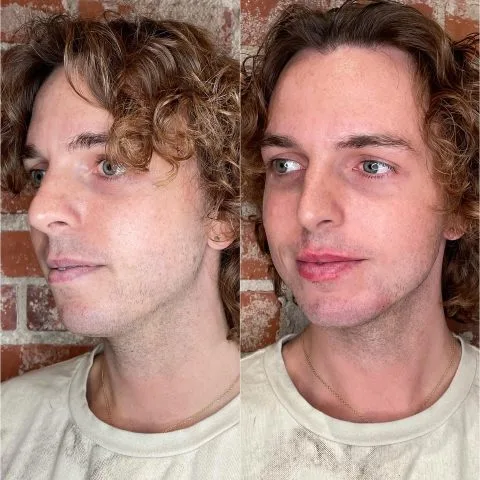 Dermal Fillers - Case 4 before and after at Rewind Aesthetics (2 of 3)