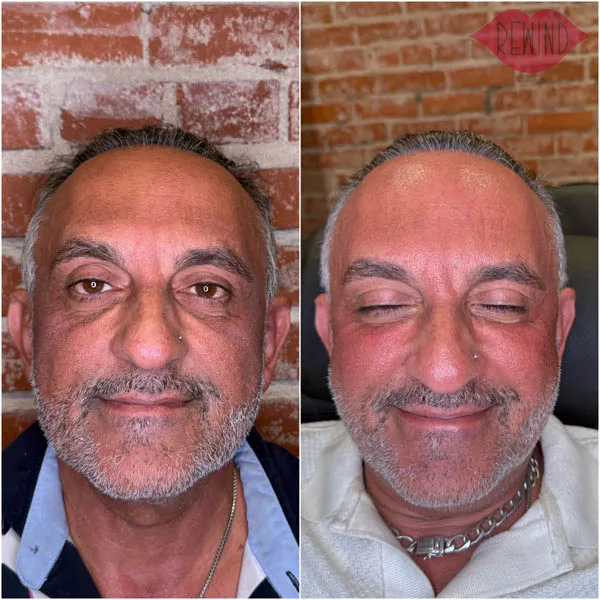 EZ Gel -Case 4 before and after