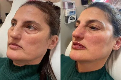 Sculptra - Case 2 before and after