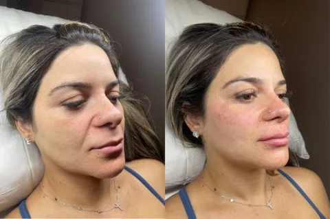 Dermal Filler - Case 1 before and after