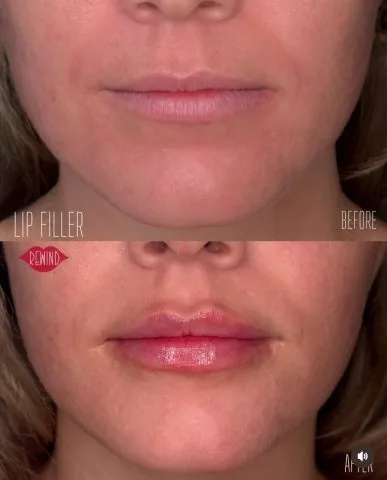 Lip Filler - Case 11 before and after