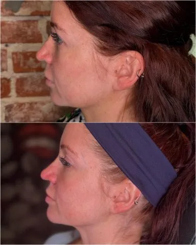 Nefertiti Neck Lift - Case 1 before and after at Rewind Aesthetics (3 of 3)