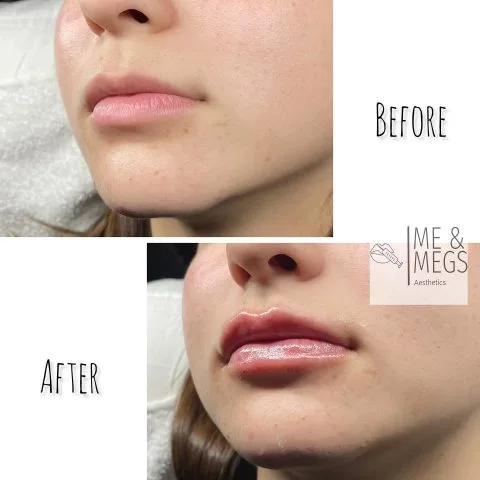 Lip Filler - Case 23 before and after