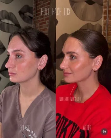 Full Face Tox with Nefertiti Neck Lift before and after at Rewind Aesthetics (2 of 2)