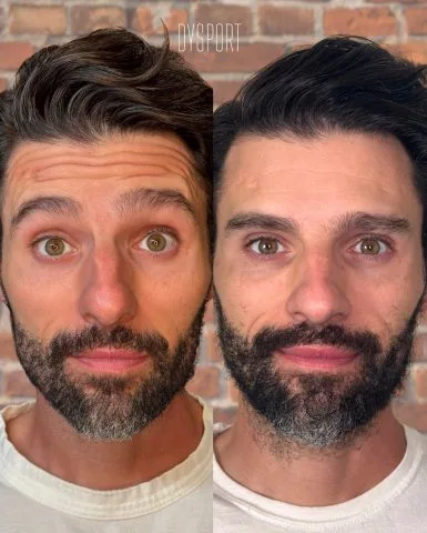 Dysport - Case 1 before and after at Rewind Aesthetics (2 of 2)