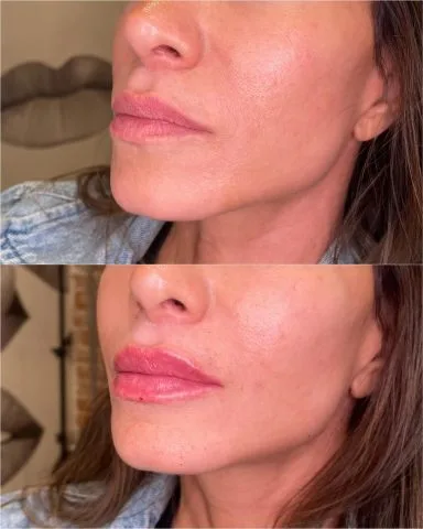 Lip Filler - Case 21 before and after