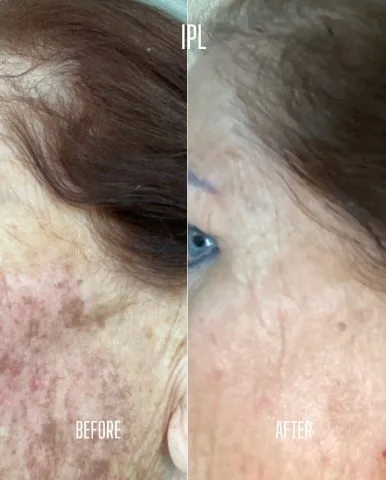 IPL - Case 1 before and after