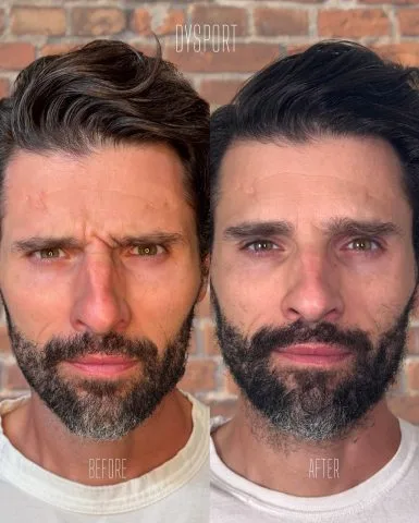 Dysport - Case 1 before and after