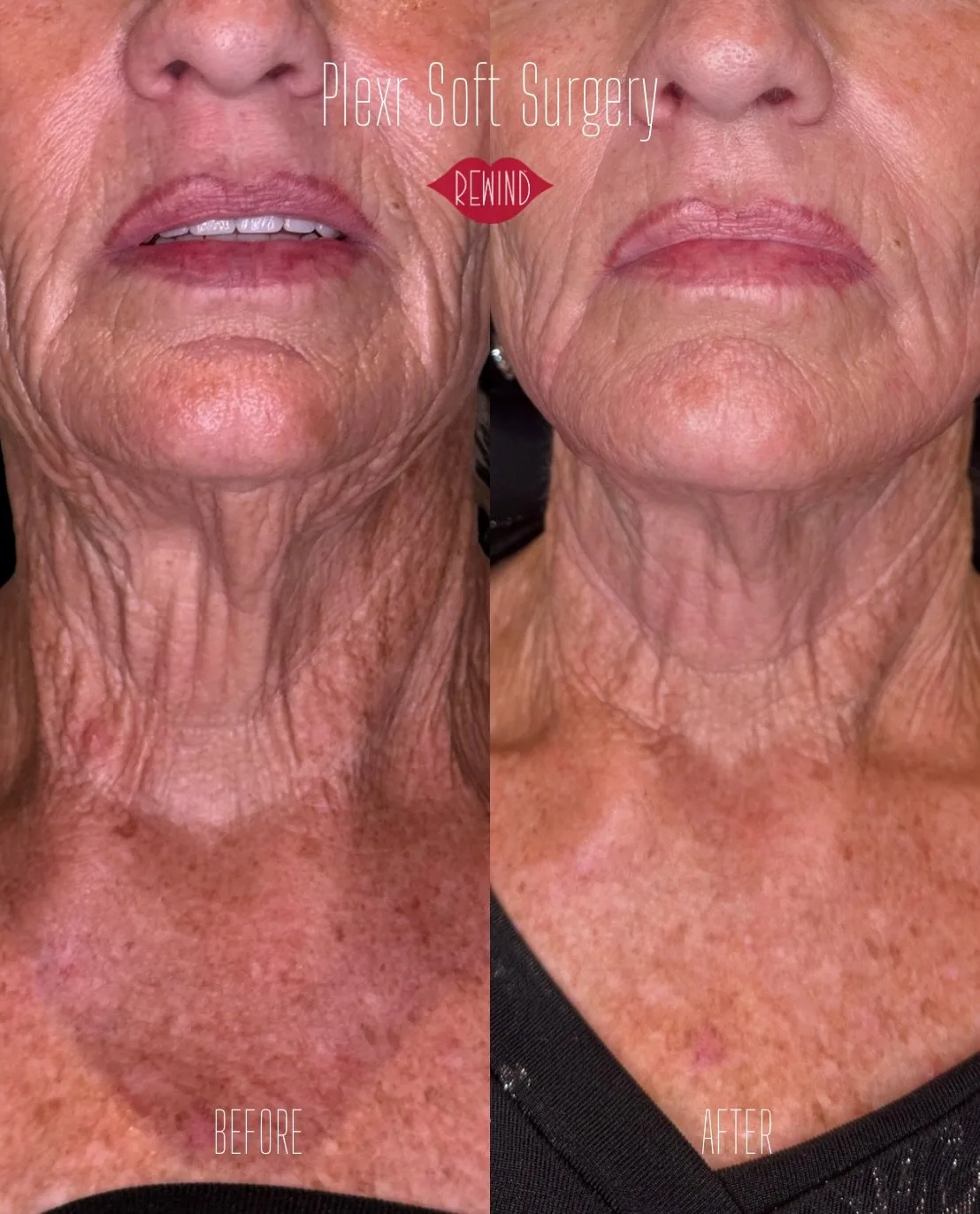 PLEXR Soft Surgery - Case 1 before and after