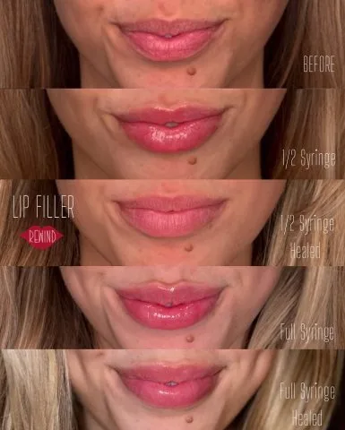 Lip Filler - Case 16 before and after at Rewind Aesthetics (2 of 3)