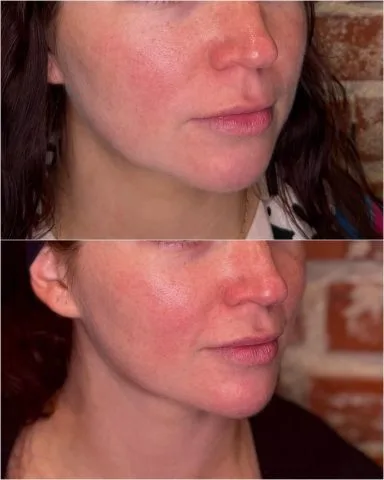Nefertiti Neck Lift - Case 1 before and after at Rewind Aesthetics (2 of 3)
