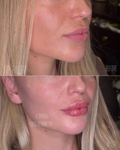 Lip Filler - Case 12 before and after at Rewind Aesthetics (3 of 3)